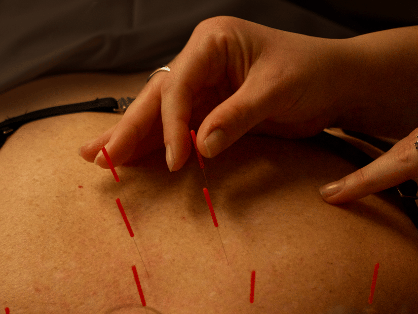  A hand inserts thin needles into a person's upper back, indicating an acupuncture treatment session.