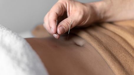 A close-up of a hand placing acupuncture needles on the stomach of a patient.