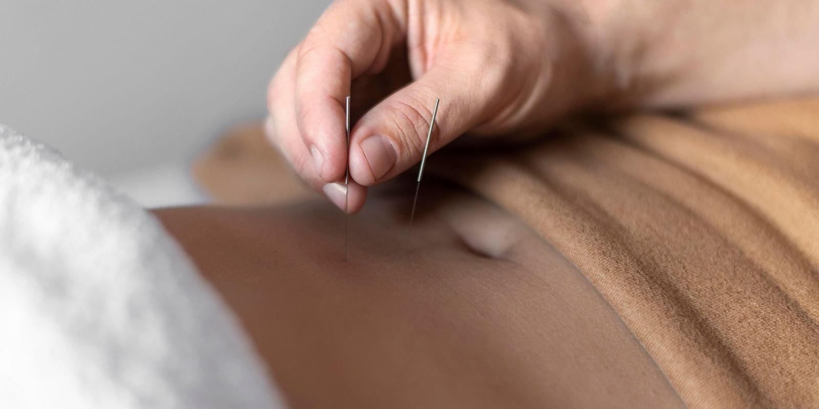 A close-up of a hand placing acupuncture needles on the stomach of a patient.