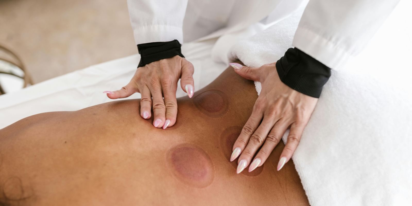 A person receives cupping therapy on their back, showing red circular marks from the suction cups. A practitioner's hands are visible.