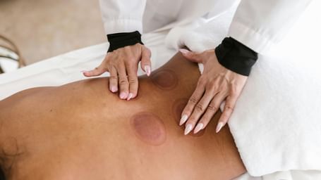 A person receives cupping therapy on their back, showing red circular marks from the suction cups. A practitioner's hands are visible.