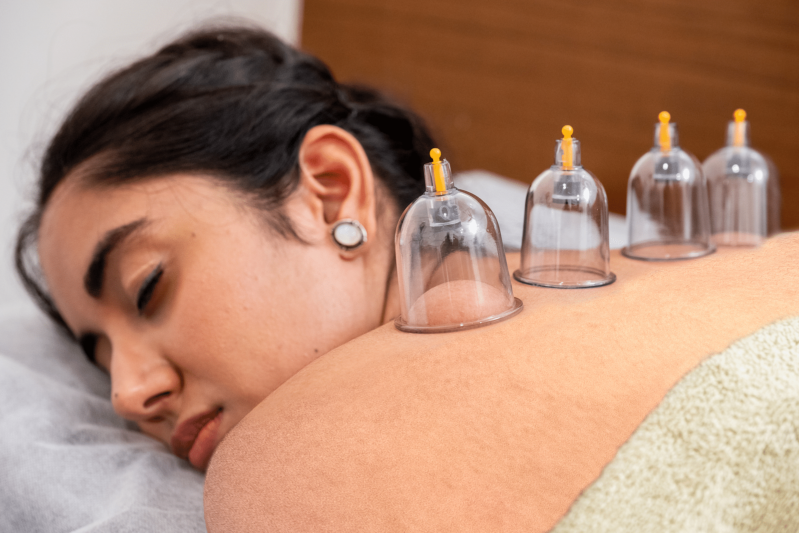 A woman receiving cup therapy at our wellness centre in Udaipur - Rajbagh Wellness, Udaipur