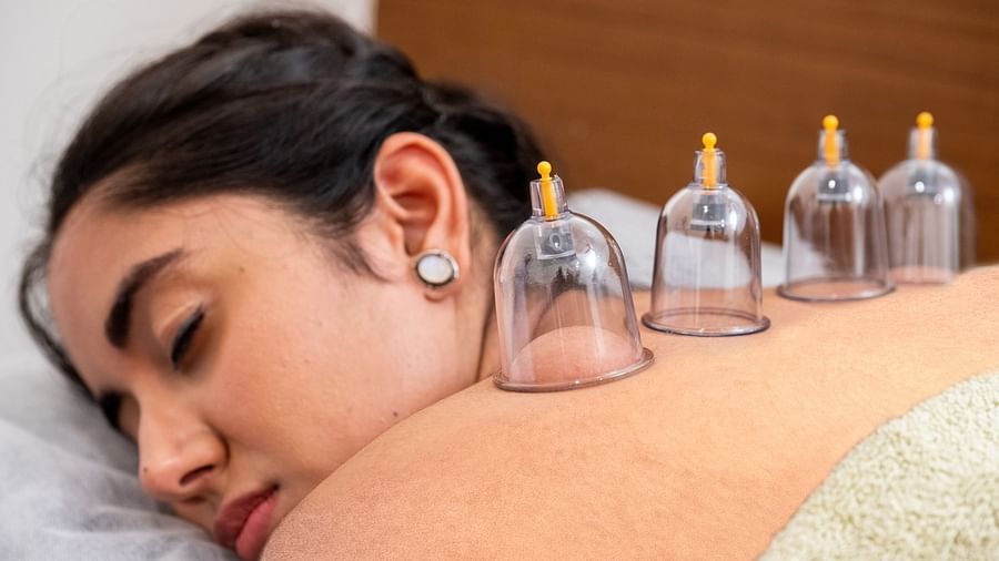 A woman receiving a cupping therapy at our wellness centre - Rajbagh Wellness, Udaipur