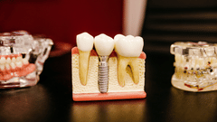 different dental aesthetics to show the damage to the tooth placed on the table