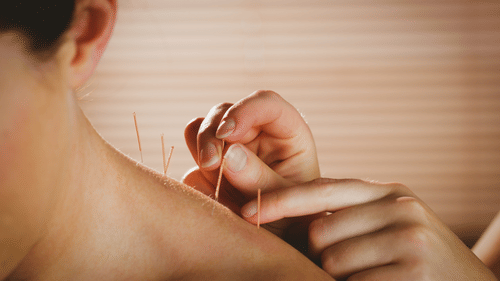 A couple of hands using acupuncture needles on the shoulder of another person