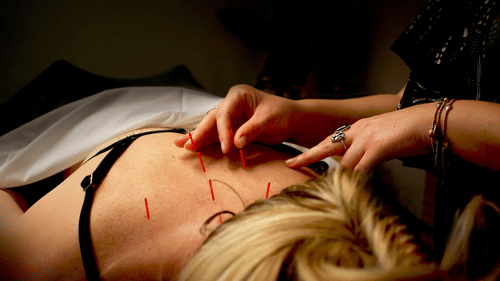 A person lying face down, with an acupuncturist's hands inserting thin needles into their back