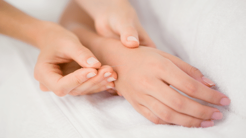 Acupuncture needle is being pierced to the back of the palm of a person