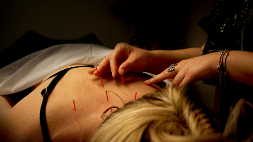 Hands of a person applying acupuncture needles to the upper back of another person lying on their stomach