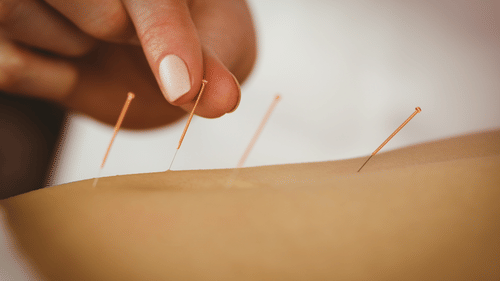 A hand placing a fine acupuncture needle into a person’s skin at YO1 Longevity & Health Resorts, with three other needles already aligned