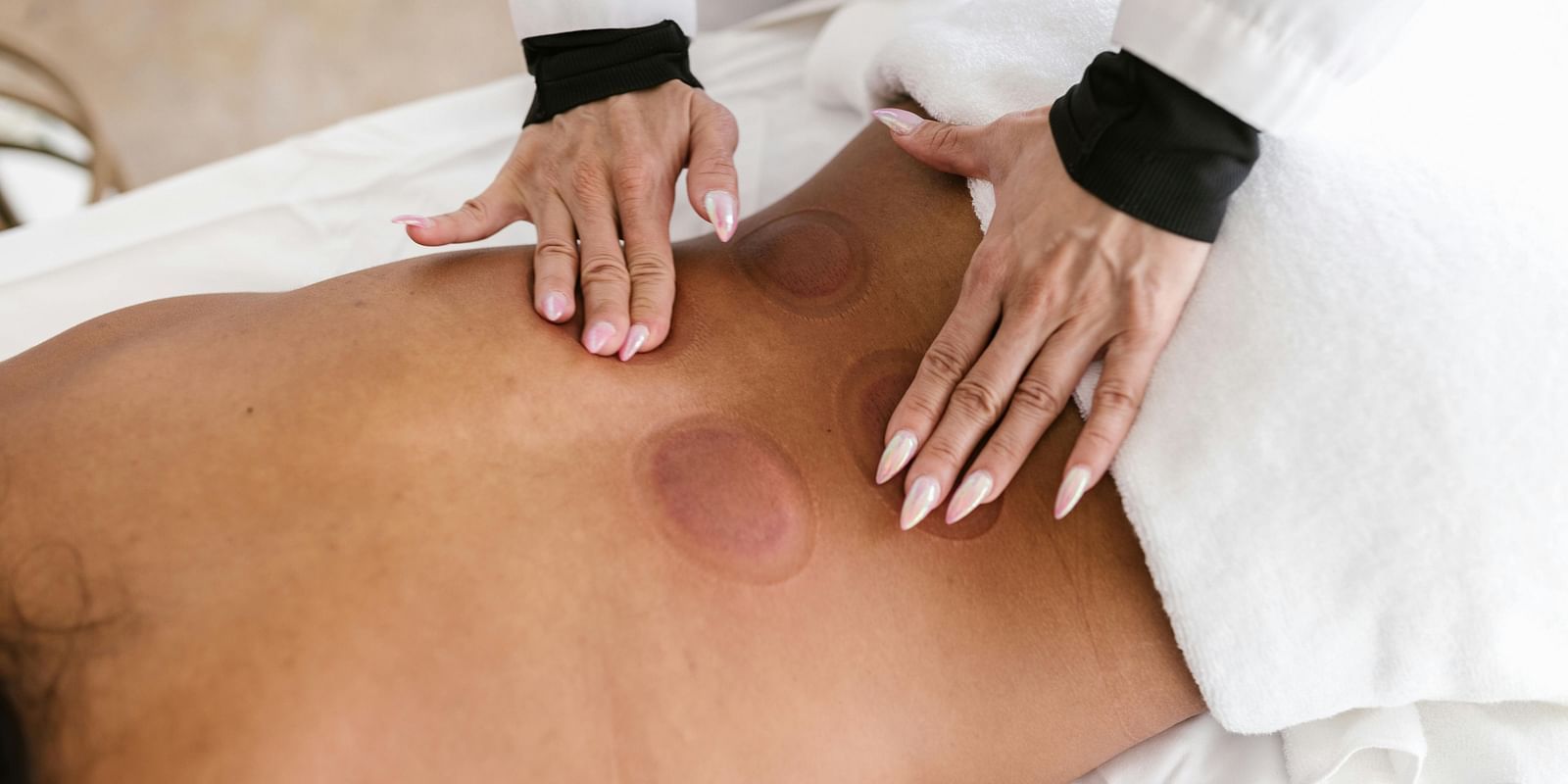 A therapist performing cupping therapy, gently pressing on the cups placed on the patient's back.