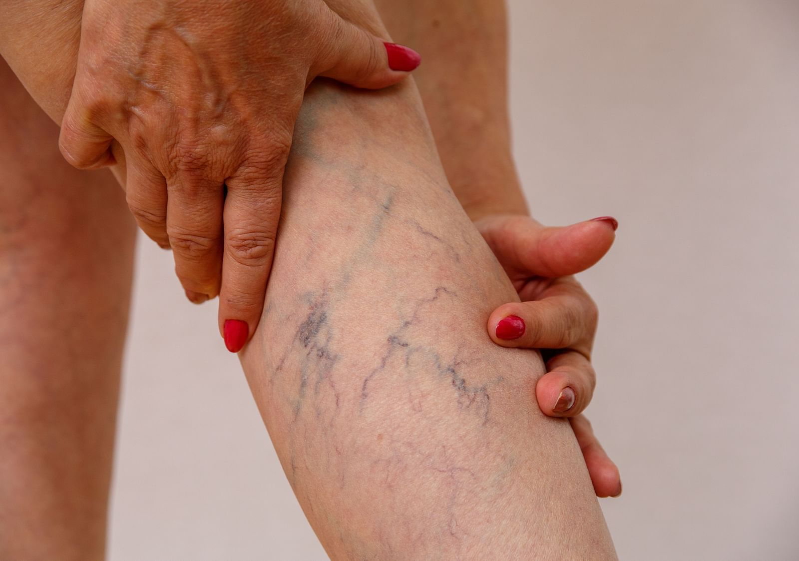 A person holding their leg with visible varicose veins - Shreyas Retreat