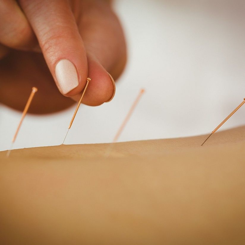 Acupuncture Needle
