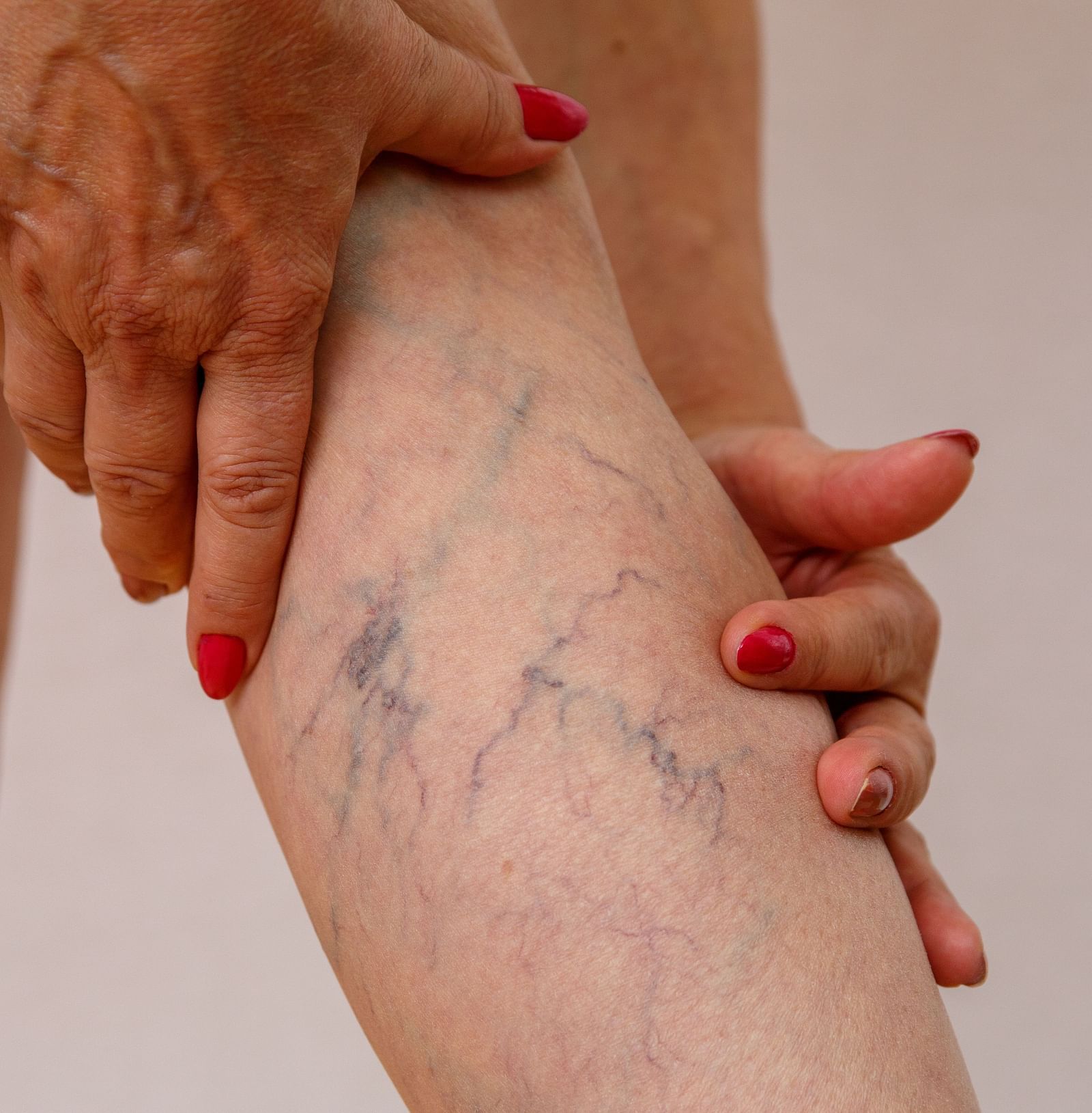 A person holding their leg with visible varicose veins - Shreyas Retreat