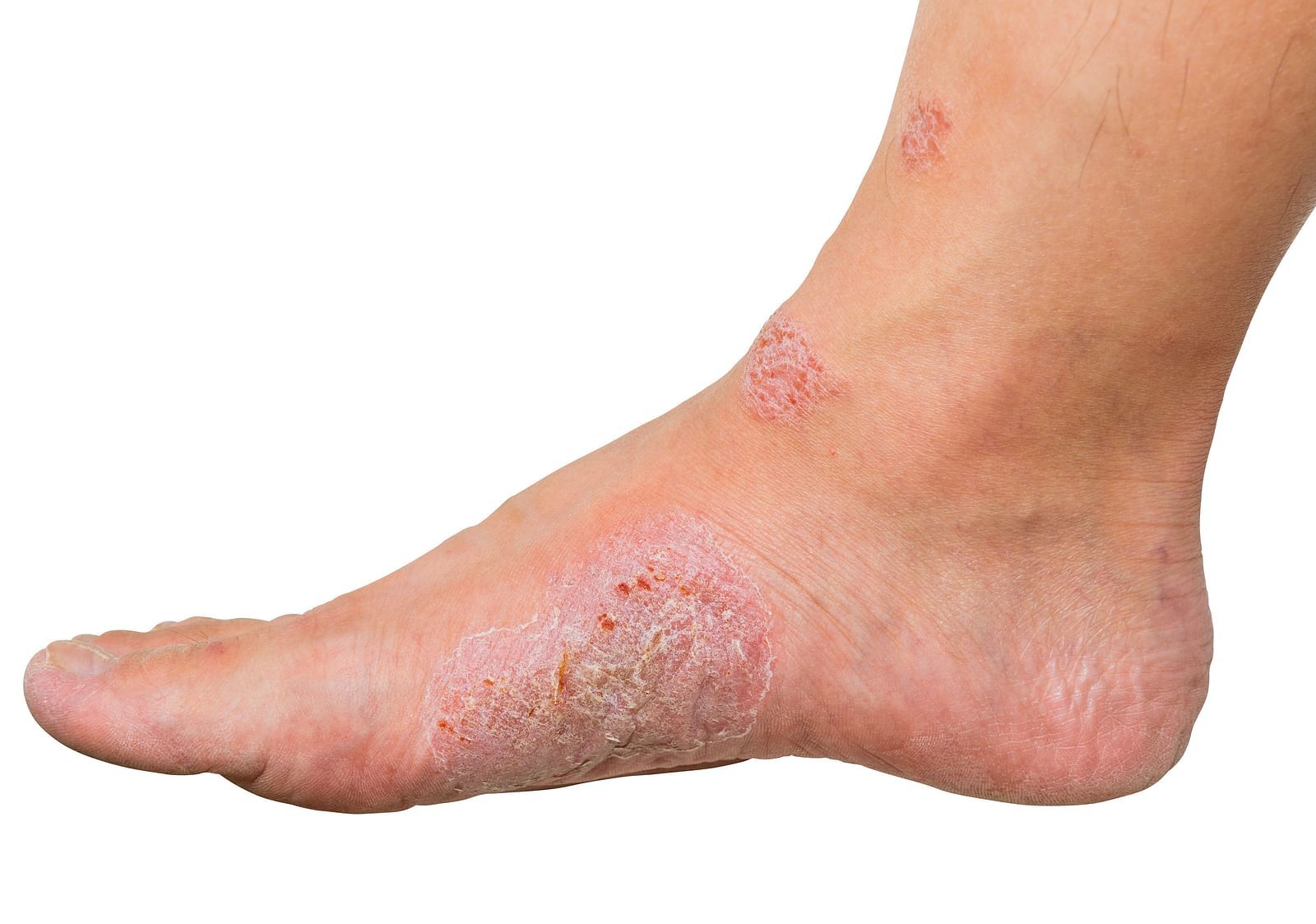 A person with a swollen foot showing signs of eczema or a skin condition - Shreyas Retreat