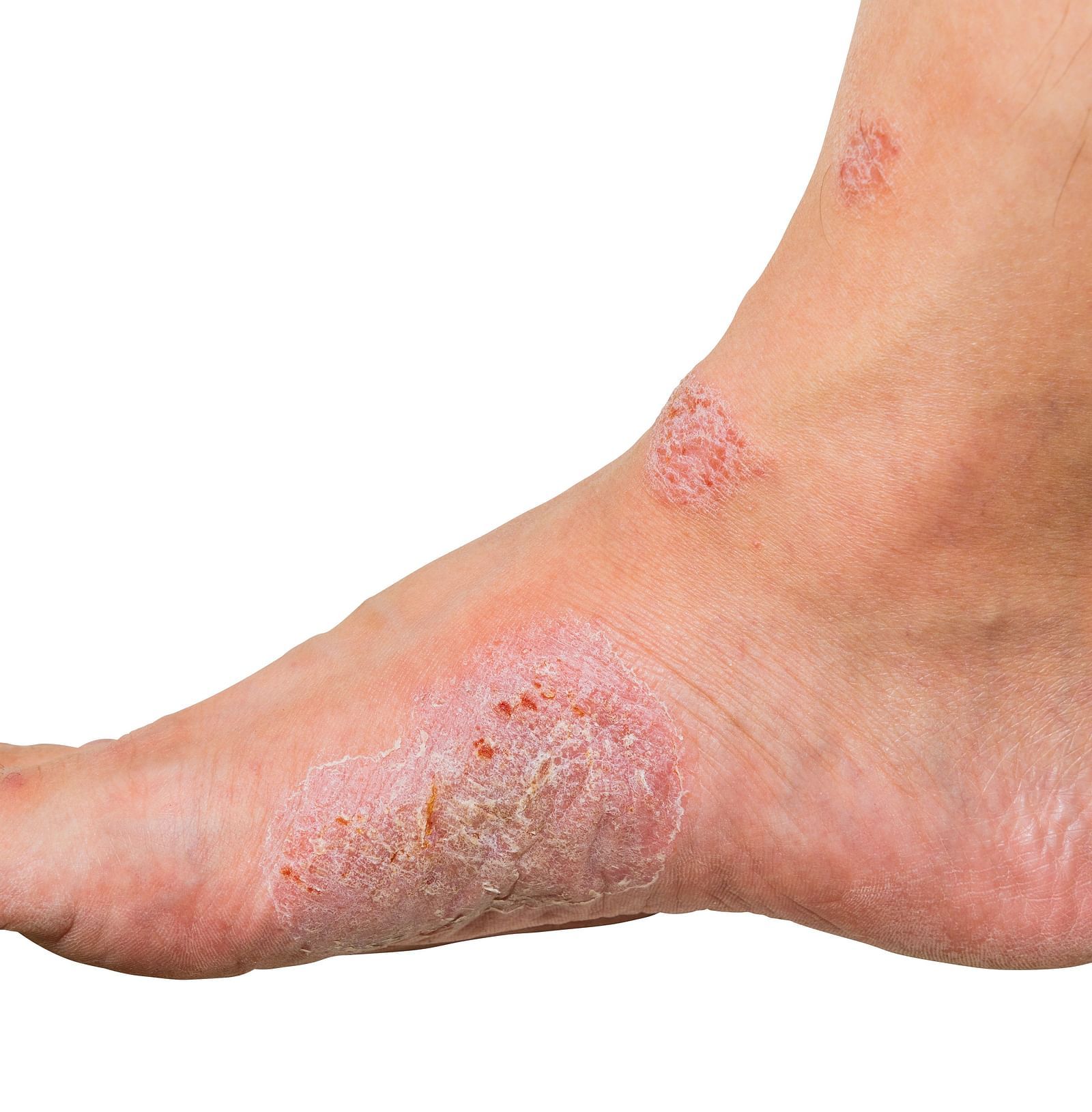 A person with a swollen foot showing signs of eczema or a skin condition - Shreyas Retreat