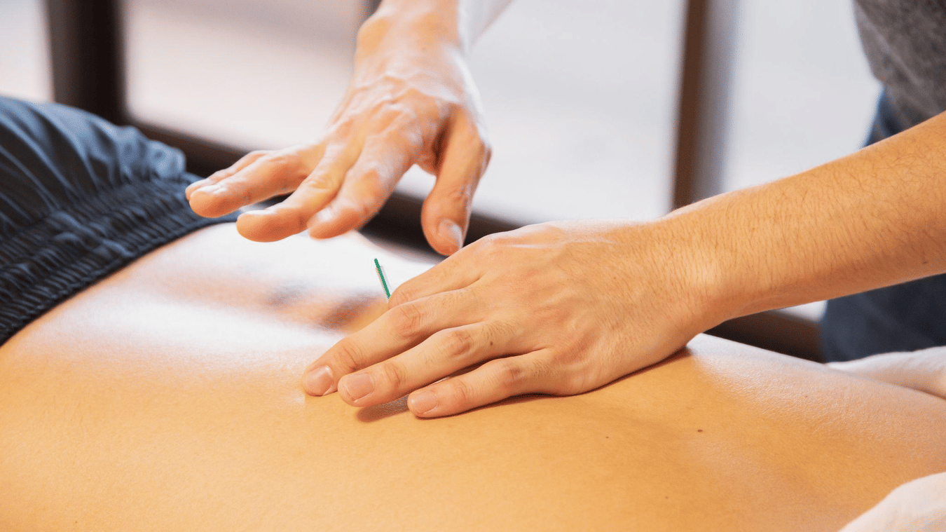A person receiving acupuncture on their back while lying on their stomach at YO1 Longevity & Health Resorts, Catskills