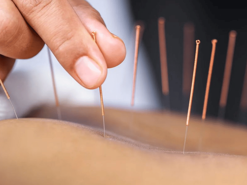 Close-up of acupuncture needles being gently inserted into the skin during a treatment session for skin health and natural glow at YO1