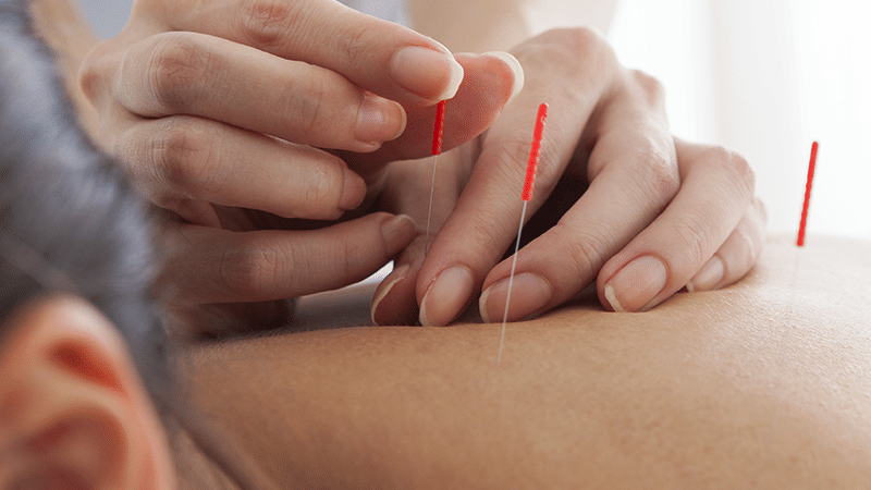 A person receiving acupuncture on their back