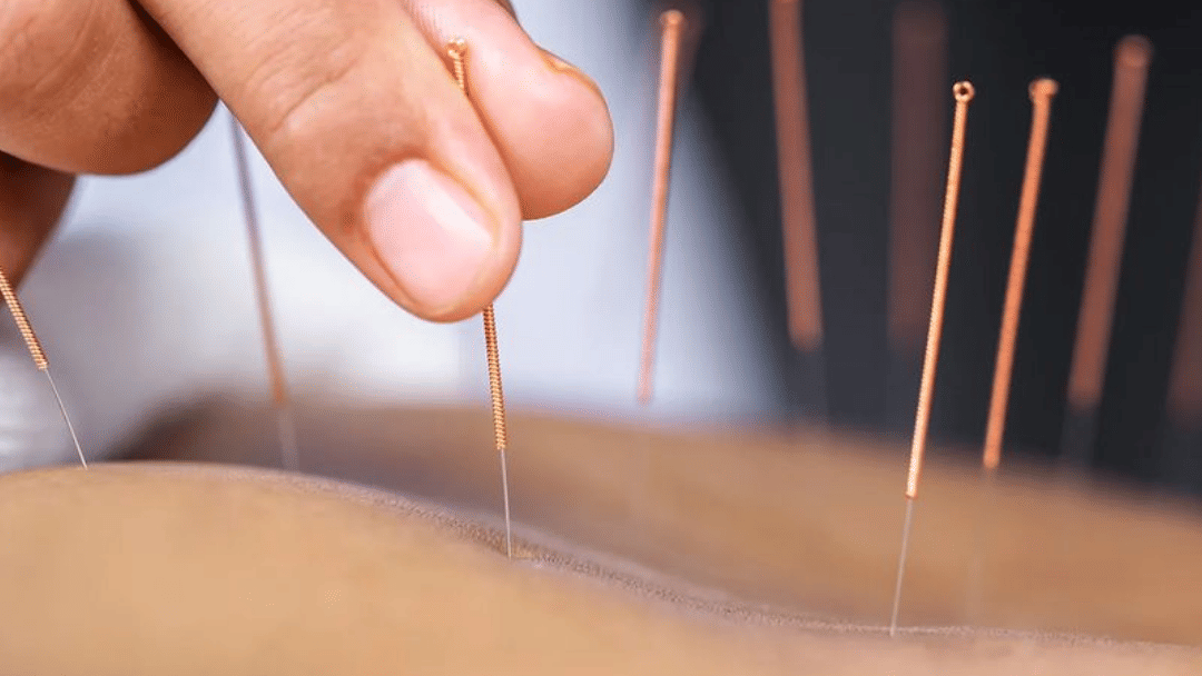 Close-up of acupuncture needles being gently inserted into the skin during a treatment session for skin health and natural glow at YO1