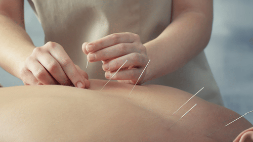 A person inserting acupuncture needles on the upper back of a person lying on their stomach