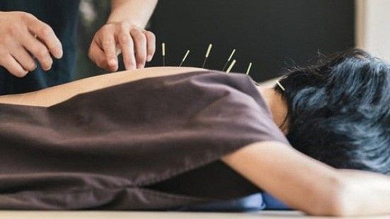 acupuncture-3