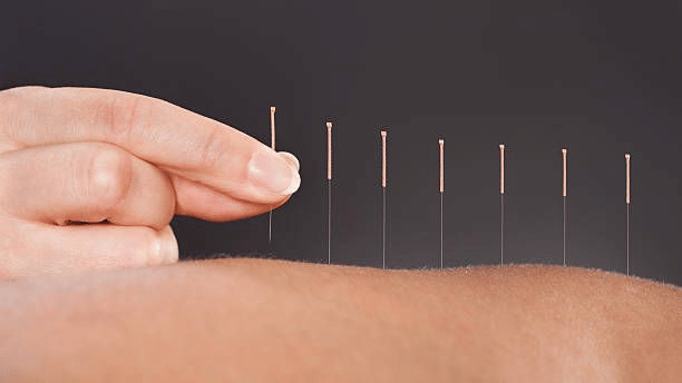 A hand inserting acupuncture needles to the skin under soft light