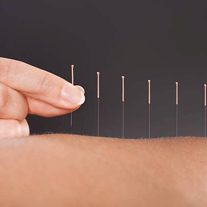 A hand inserting acupuncture needles to the skin under soft light