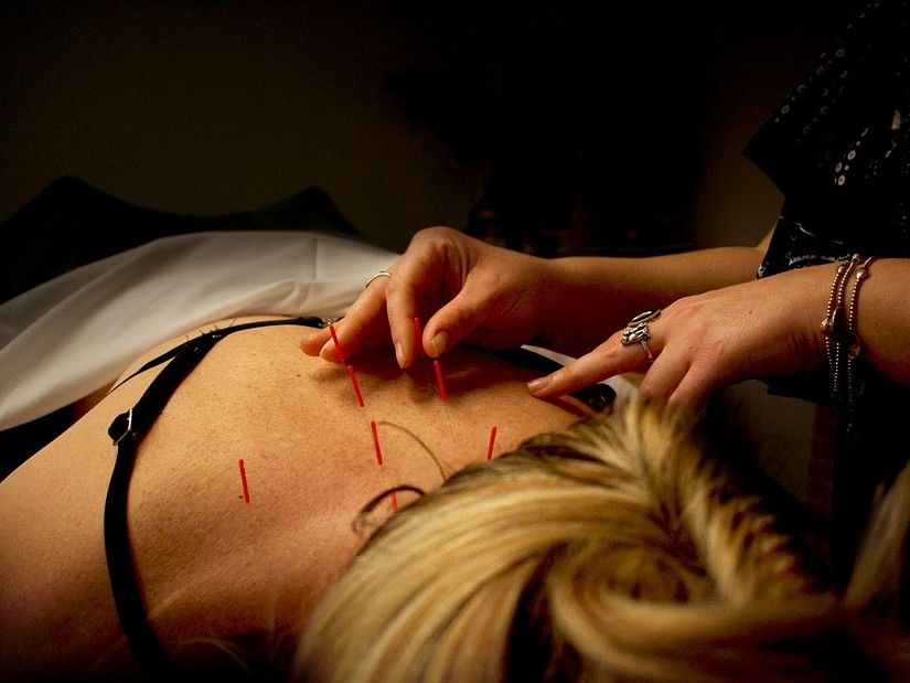 A woman recieving acupuncture on her back while lying on her stomach