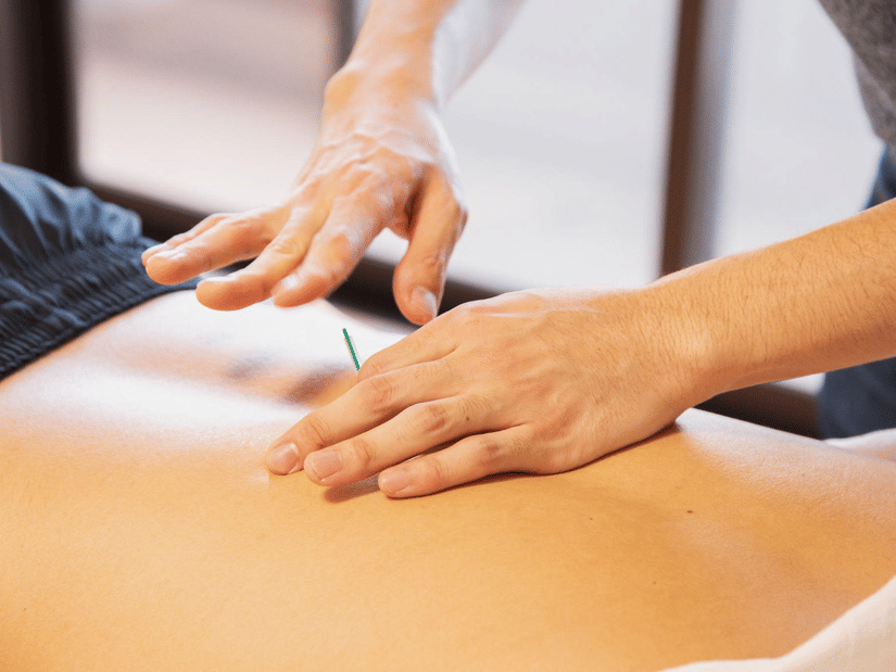 A person receiving acupuncture on their back while lying on their stomach at YO1 Longevity & Health Resorts, Catskills