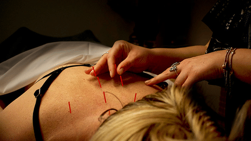 a person's back with several acupuncture needles inserted, while hands gently apply more needles.