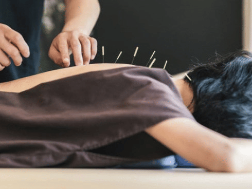 A person lying facedown and another person placing acupuncture needles along the back