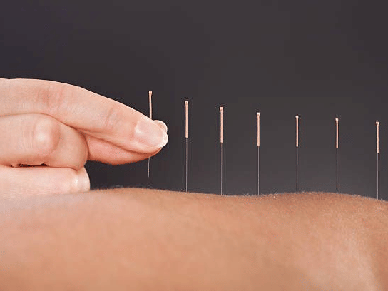 A hand inserting acupuncture needles to the skin under soft light